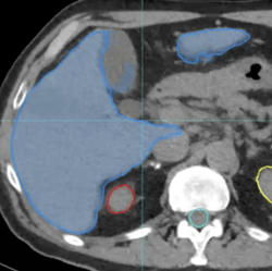 liver contour - 3a -contour copilot