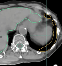 lung contour - 1b