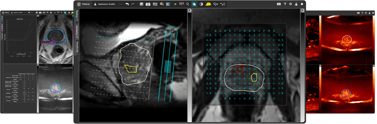 Three images of medical scans with drawn contours on certain areas of the images. Three images of medical scans with drawn contours on certain areas of the images.