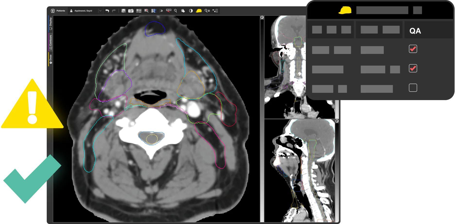 Contour QA in MIM Maestro. Alert and checkmarks over contoured head and neck radiation oncology case. Contour QA in MIM Maestro. Alert and checkmarks over contoured head and neck radiation oncology case.